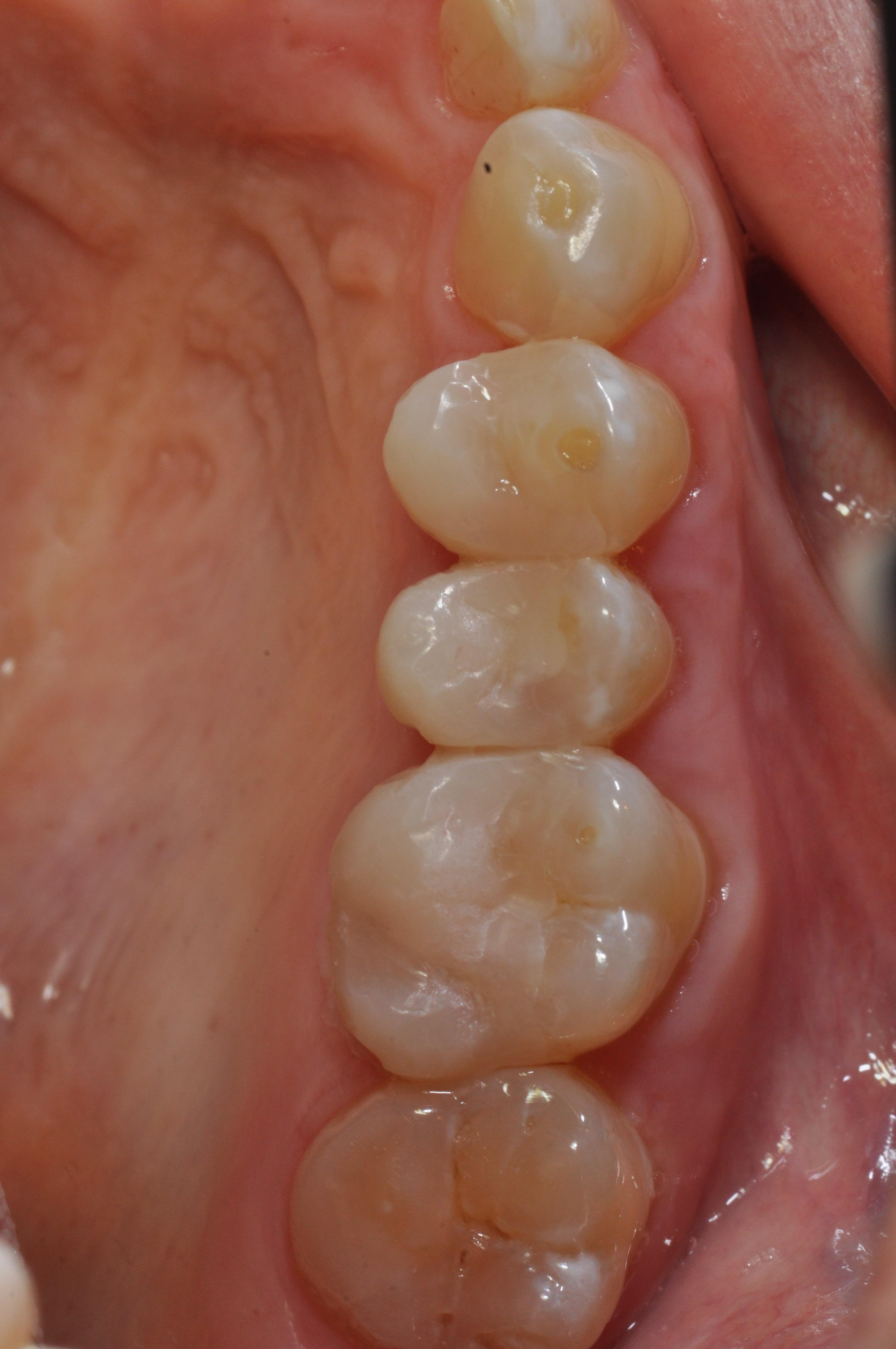 Aufgebaute Zähne unmittelbar nach der Behandlung