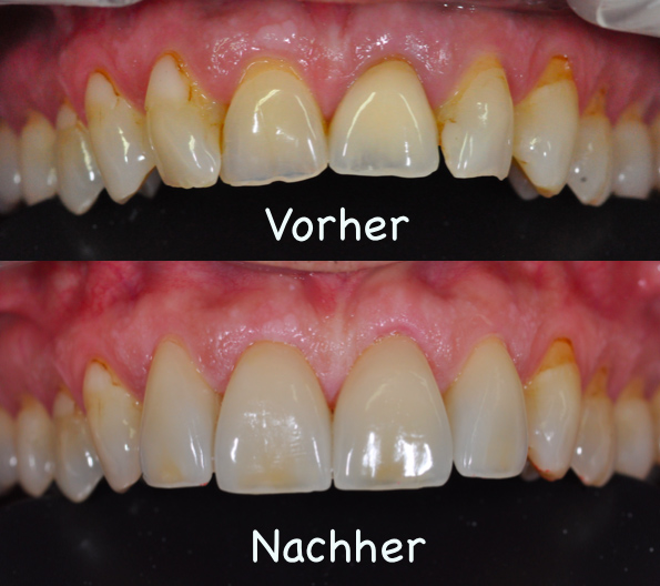 Frontzahnersatz Februar 2016